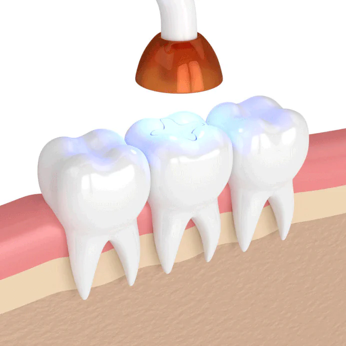 Fillings & Sealants