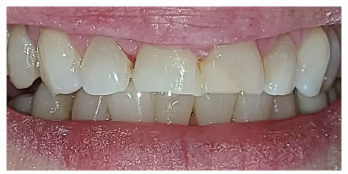 After anterior composite fillings