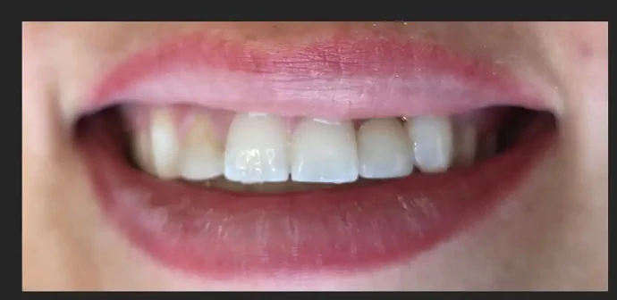 After Anterior Dental Implant