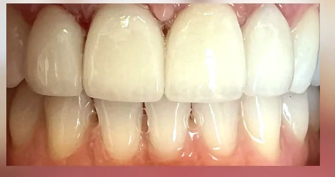 After ceramic veneers