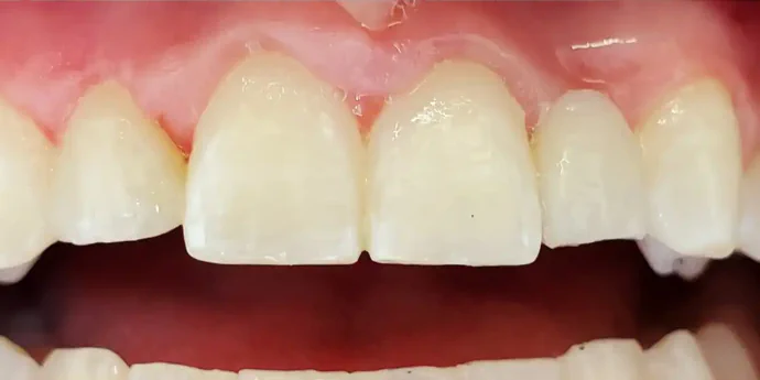 After composite veneers