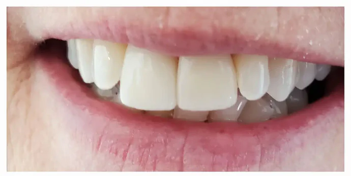 After dental crowns and veneers