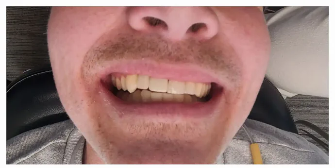 After Implant-Supported Bridge