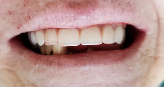 After upper dentures
