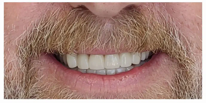 After dental veneers and crowns
