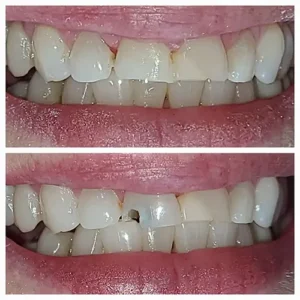 Tooth Fillings in Bluffdale, UT