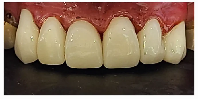 After anterior dental crowns