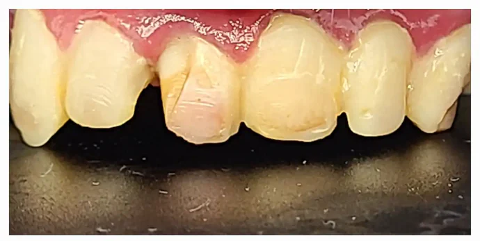 Before anterior dental crowns