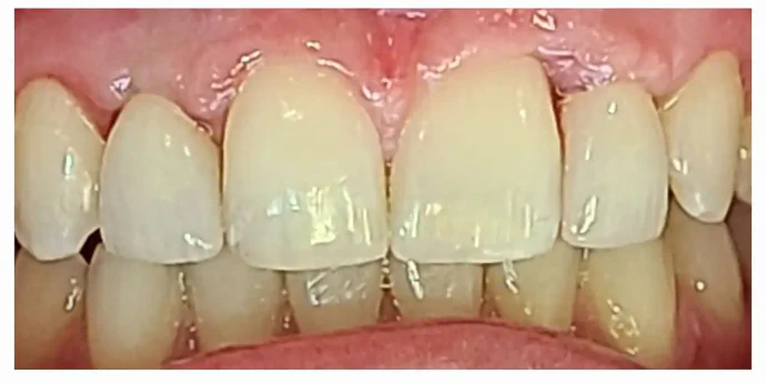 After Anterior Dental Implants