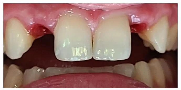 Before Anterior Dental Implants