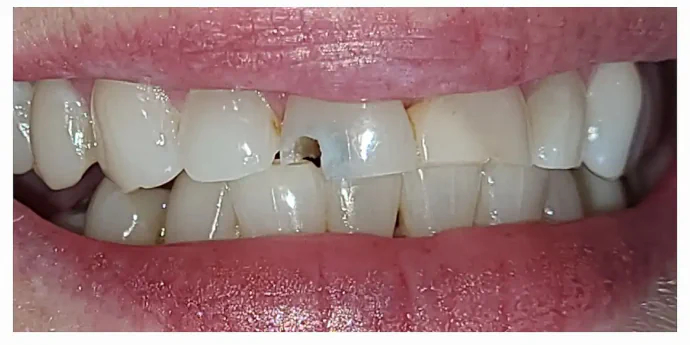 Before anterior composite fillings