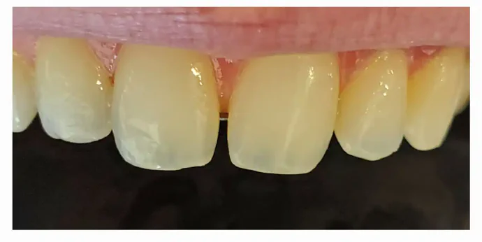 Before Anterior cosmetic composite bonding