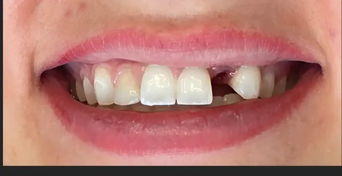 Before Anterior Dental Implant