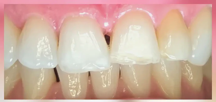 Before ceramic veneers