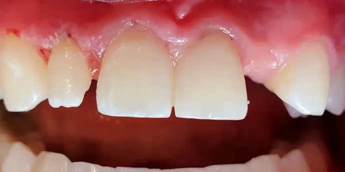 Before composite veneers