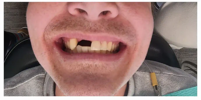 Before Implant-Supported Bridge