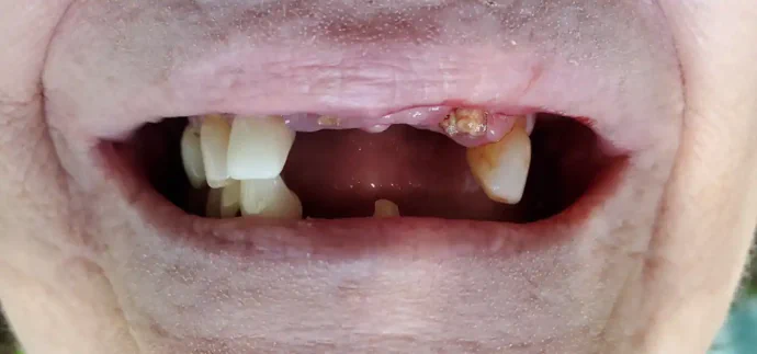 Before upper dentures