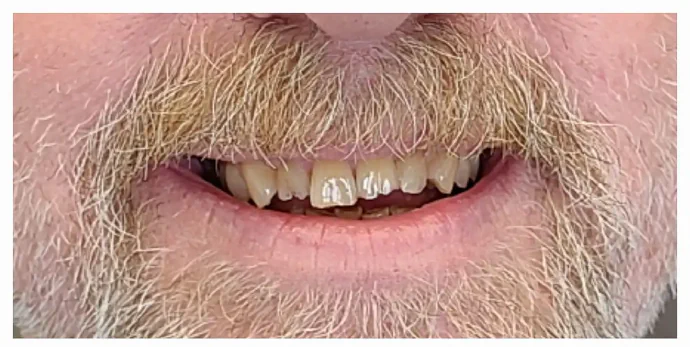 Before dental veneers and crowns