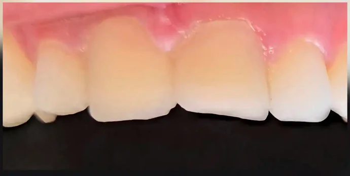 Before dental crowns