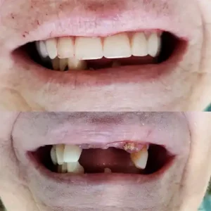 Dentures before and after in Bluffdale, UT