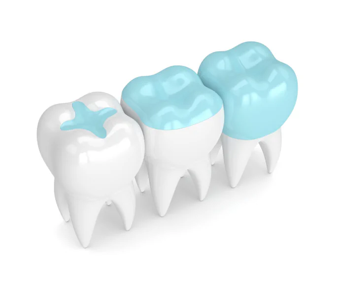 Dental Sealants in Bluffdale, UT at Bluffdale Dental