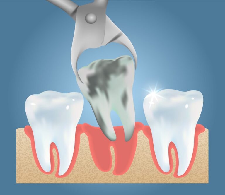 Dental Tooth Extraction Pulling Tooth From Root With Dental Tool Illustration